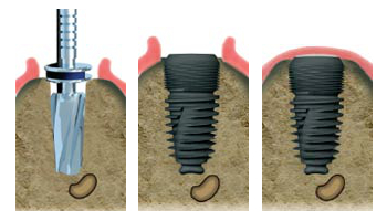 Implants dentaires Courbevoie