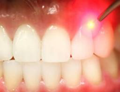 Laser dentaire Centre Dentaire Bagnolet