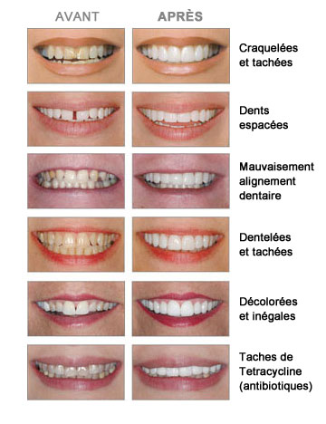facettes dentaires esthétique dentaire Bagnolet