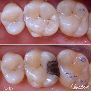 onlay en composite dentiste bagnolet