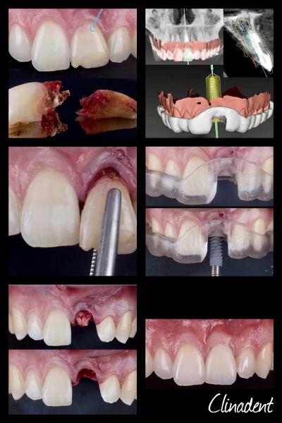 Implants dentaire à Bagnolet