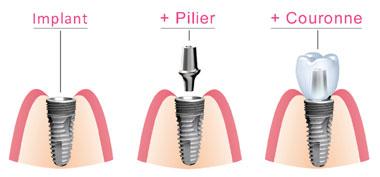 Composants implant dentaire Bagnolet 93170
