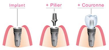 Couronne dentaire ou prothèse sur implants: que choisir? - Dentisterie Hanok