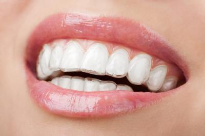 aligneurs orthodontistes centre dentaire les lilas Bagnolet