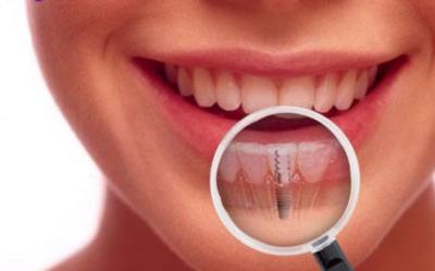 implant dentaire pas cher, implant bagnolet, implant les lilas
