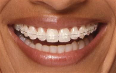 traitement orthodontiste Bagnolet Les Lilas